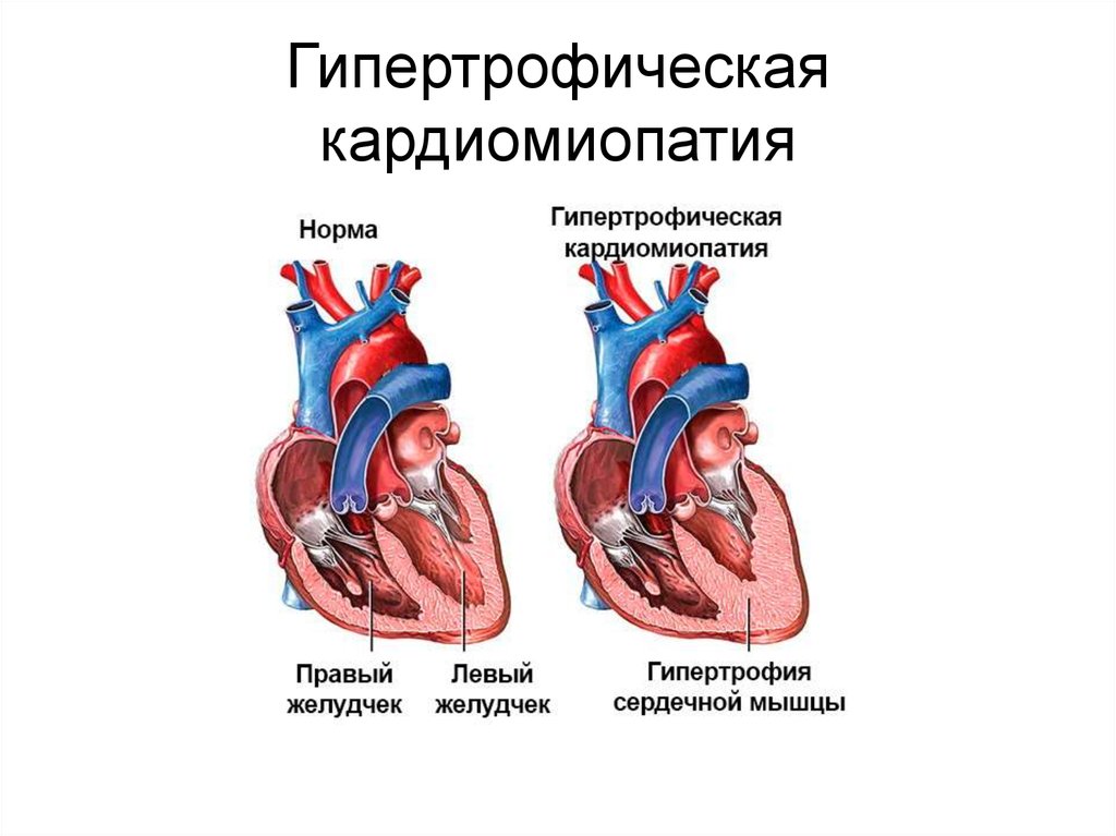Гипертрофическая кардиомиопатия 
